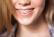 Лингвальные, лигатурные и самолигирующие брекеты: как выбрать систему
